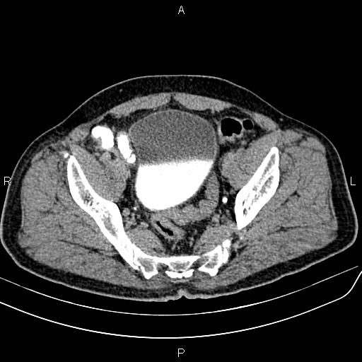 File:Cecal cancer with appendiceal mucocele (Radiopaedia 91080-108651 Axial C+ delayed 68).jpg