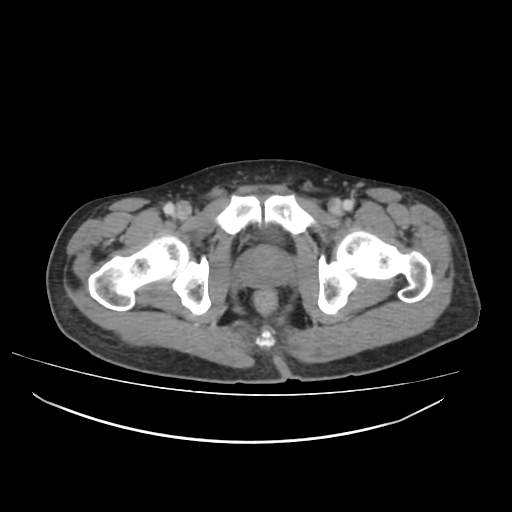 Cecal carcinoma with local lymphadenopathy (Radiopaedia 31428-32240 A 54).jpg