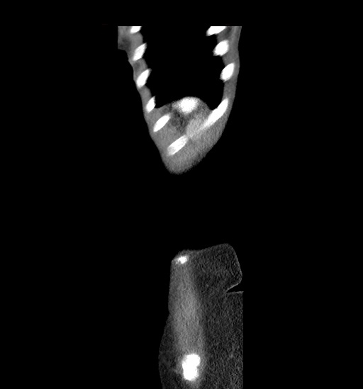 Cecal volvulus (Radiopaedia 48543-53513 C 50).jpg
