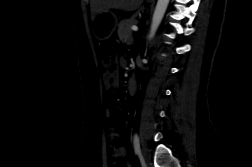 Celiac artery compression syndrome (Radiopaedia 47538-52152 B 61).jpg