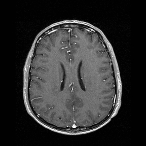 Central-variant posterior reversible encephalopathy syndrome (PRES) (Radiopaedia 43880-47358 Axial T1 C+ 107).jpg