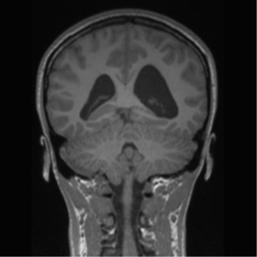 Central neurocytoma (Radiopaedia 37664-39557 Coronal T1 32).png