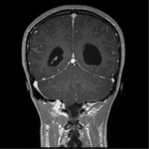 Central neurocytoma (Radiopaedia 37664-39557 Coronal T1 C+ 27).png