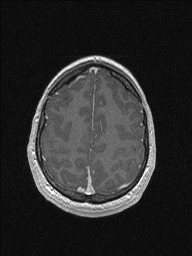 Central neurocytoma (Radiopaedia 56690-63469 Axial T1 C+ 136).jpg