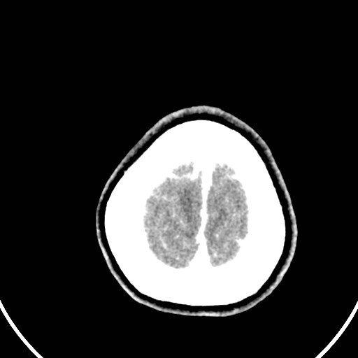 Central neurocytoma (Radiopaedia 84497-99871 B 47).jpg
