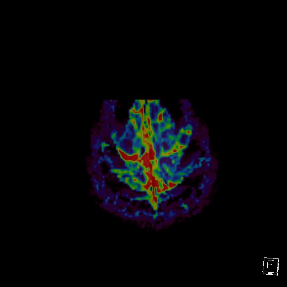 Central neurocytoma (Radiopaedia 84497-99872 Axial Perfusion 17).jpg
