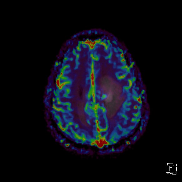 Central neurocytoma (Radiopaedia 84497-99872 Axial Perfusion 74).jpg