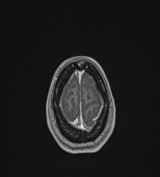 Central neurocytoma (Radiopaedia 84497-99872 Axial T1 C+ 139).jpg