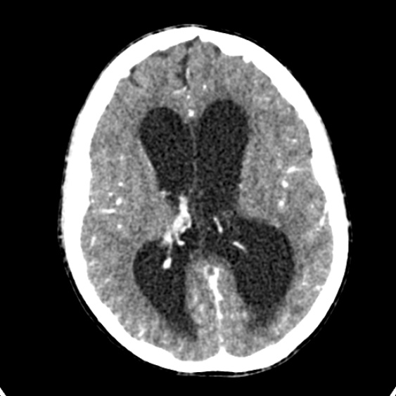 Cerebellar abscess secondary to mastoiditis (Radiopaedia 26284-26412 Axial C+ delayed 87).jpg