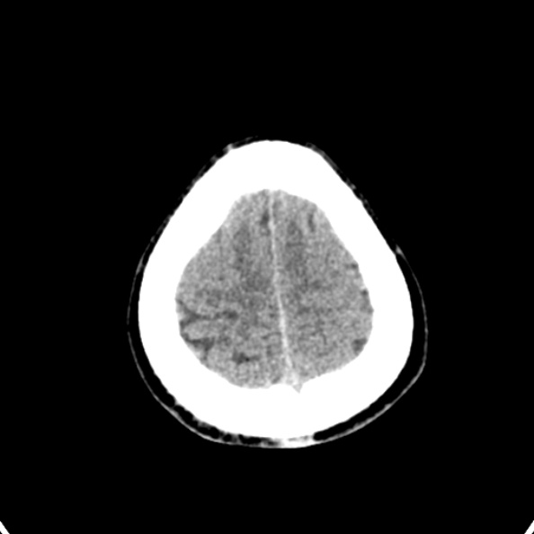 Cerebellar abscess secondary to mastoiditis (Radiopaedia 26284-26412 Axial non-contrast 142).jpg