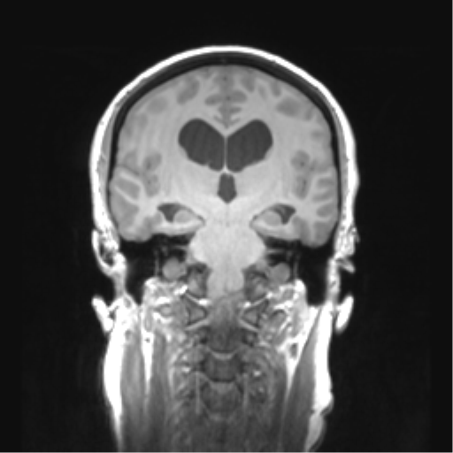 Cerebellar ependymoma complicated by post-operative subdural hematoma (Radiopaedia 83322-97736 Coronal T1 30).png