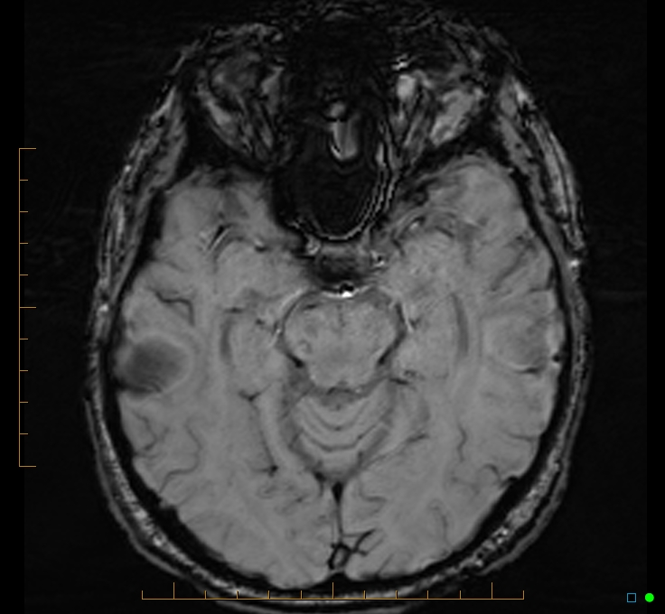 Cerebellar gangliocytoma (Radiopaedia 65377-74422 Axial SWI 22).jpg