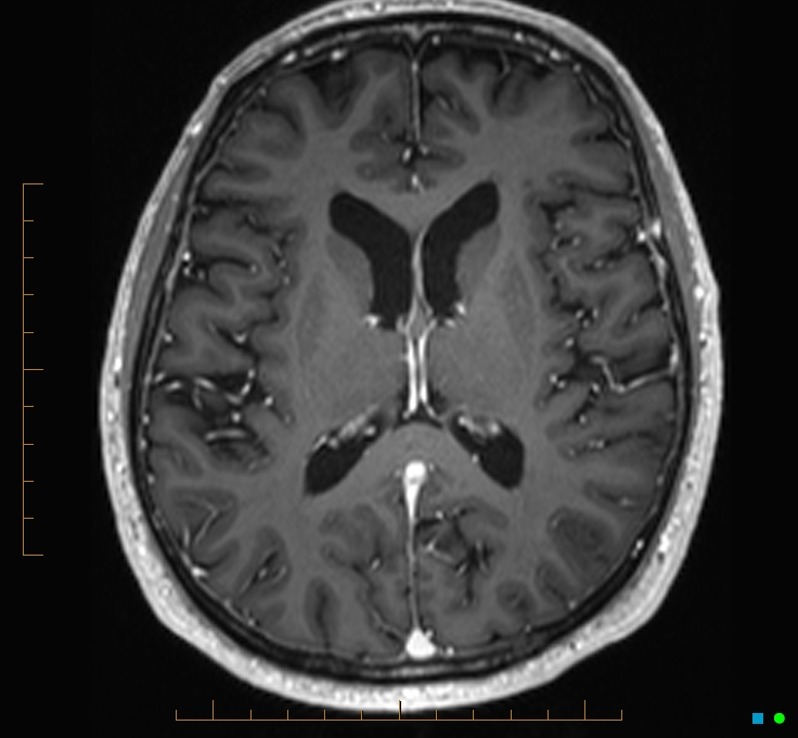 Cerebellar gangliocytoma (Radiopaedia 65377-74422 Axial T1 C+ 74).jpg