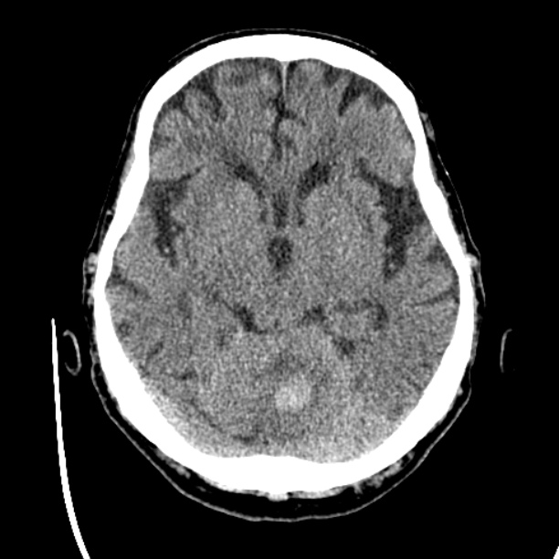 Cerebellar hemorrhage (Radiopaedia 27193-27359 Axial non-contrast 20).jpg