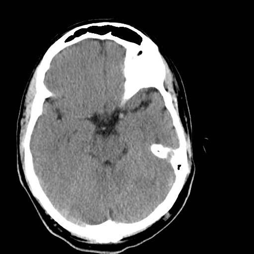 File:Cerebellar infarct due to vertebral artery dissection with posterior fossa decompression (Radiopaedia 82779-97029 Axial non-contrast 9).png