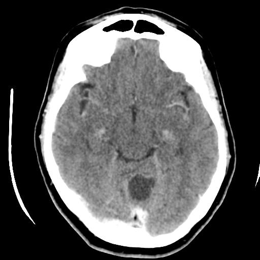 File:Cerebellar metastasis (cystic appearance) (Radiopaedia 41395-44258 B 21).png