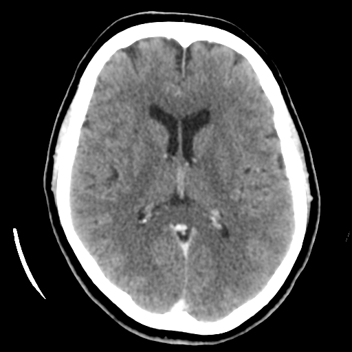 Cerebellar metastasis (cystic appearance) (Radiopaedia 41395-44258 B 28).png