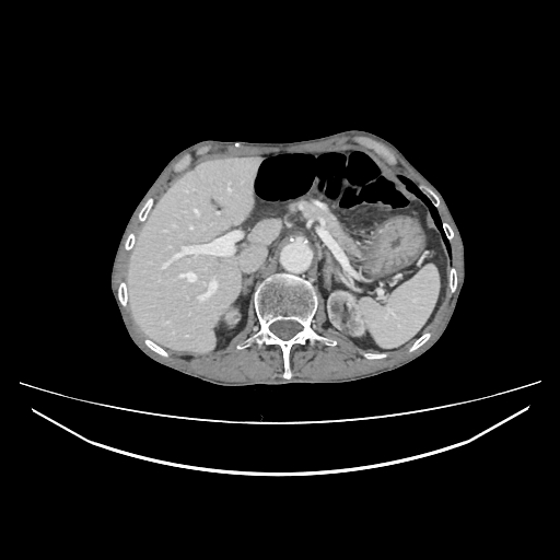 Cerebellar metastasis - lung tumor (Radiopaedia 69317-79150 A 37).jpg