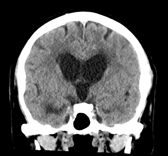 File:Cerebellar metastasis from lung adenocarcinoma (Radiopaedia 86690-102828 Coronal non-contrast 18).png