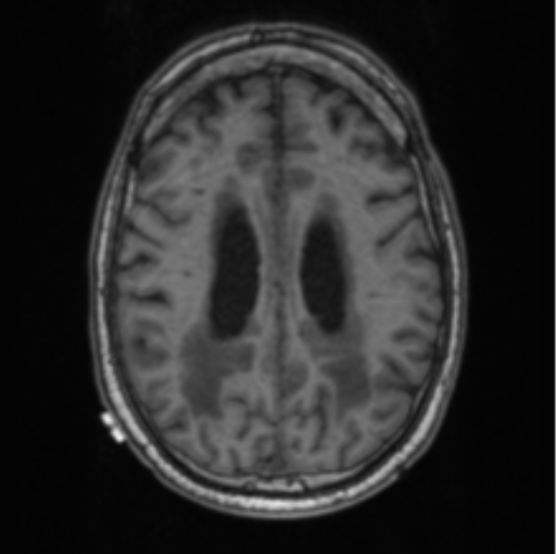 File:Cerebellar metastasis from lung adenocarcinoma (Radiopaedia 86690-102829 Axial T1 56).png