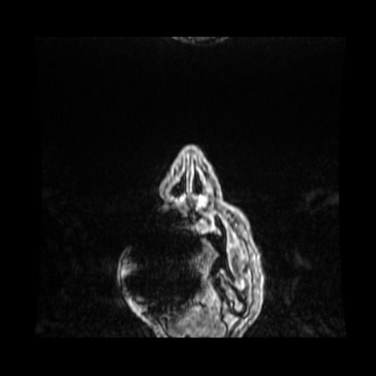 File:Cerebellar metastasis of pulmonary adenocarcinoma, cavernous venous malformation, and developmental venous anomaly (Radiopaedia 85827-101661 Coronal T1 C+ 105).jpg