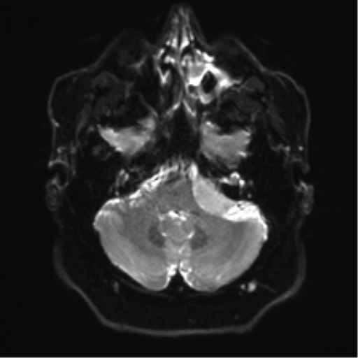 Cerebellopontine angle meningioma (Radiopaedia 48434-53348 Axial DWI 8).png