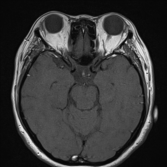 File:Cerebellopontine angle meningioma (Radiopaedia 53561-59591 Axial T1 19).jpg