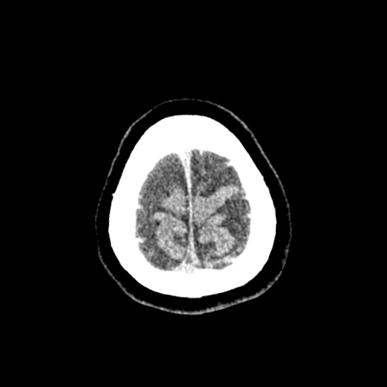 Cerebellopontine angle meningioma (Radiopaedia 53561-59592 Axial non-contrast 64).jpg