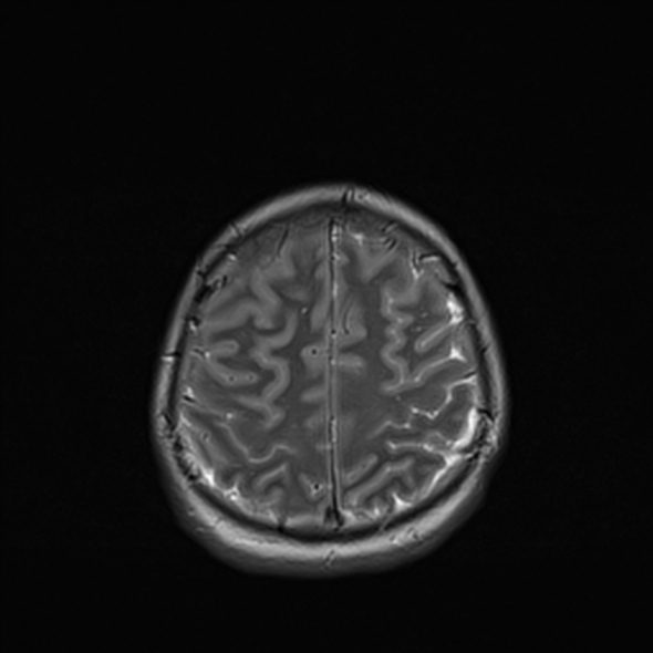Cerebral abscess (Radiopaedia 24212-24478 Axial T2 49).jpg