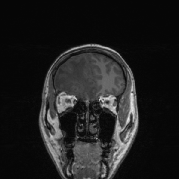 Cerebral abscess (Radiopaedia 24212-24478 Coronal T1 56).jpg