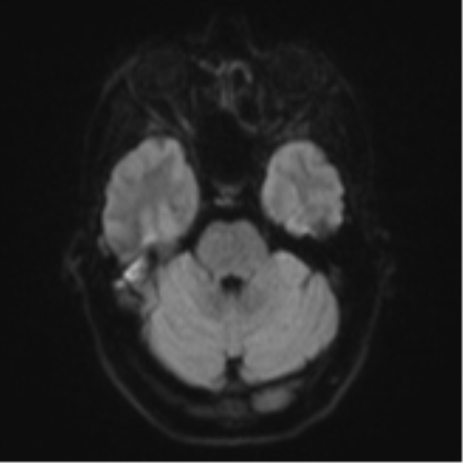 Cerebral abscess (Radiopaedia 60342-68009 Axial DWI 46).png