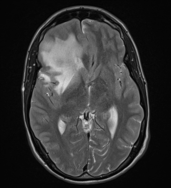 File:Cerebral abscess (Radiopaedia 60342-68009 Axial T2 16).png