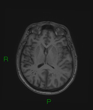 Cerebral abscess and subdural empyema (Radiopaedia 84436-99779 Axial T1 40).jpg