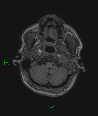 Cerebral abscess and subdural empyema (Radiopaedia 84436-99779 Axial T1 75).jpg