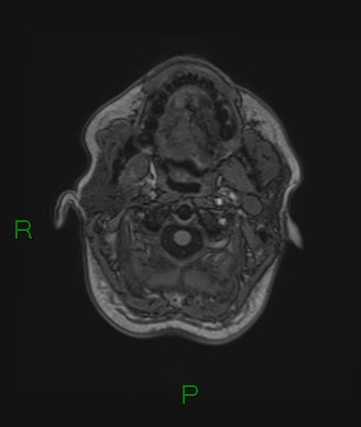 Cerebral abscess and subdural empyema (Radiopaedia 84436-99779 Axial T1 83).jpg