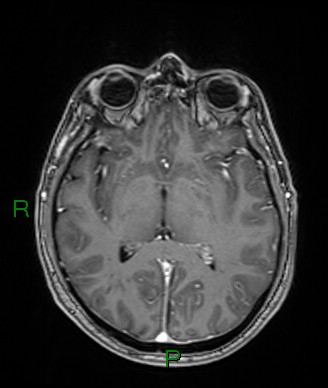 Cerebral abscess and subdural empyema (Radiopaedia 84436-99779 Axial T1 C+ 45).jpg