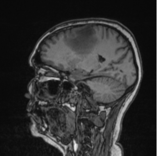 Cerebral abscess from pulmonary arteriovenous malformation (Radiopaedia 86275-102291 Sagittal T1 61).png