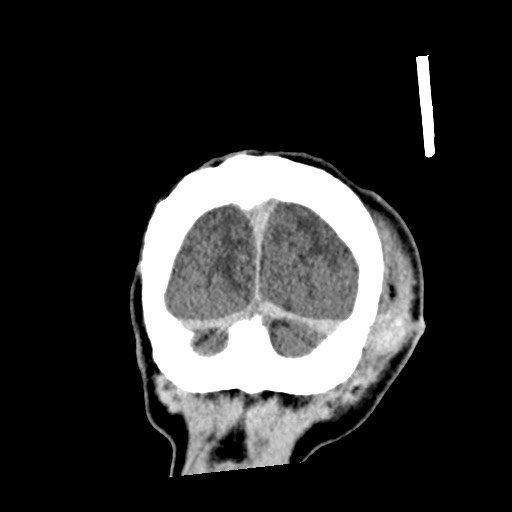File:Cerebral amyloid angiopathy-related inflammation (Radiopaedia 74836-85848 Coronal non-contrast 66).jpg