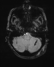 File:Cerebral amyloid angiopathy-related inflammation (Radiopaedia 74836-85849 Axial SWI 13).jpg