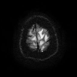 Cerebral amyloid angiopathy (Radiopaedia 28698-28978 Axial DWI 28).jpg
