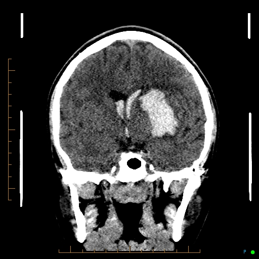 Cerebral arteriovenous malformation (AVM) (Radiopaedia 78162-90706 Coronal non-contrast 46).jpg