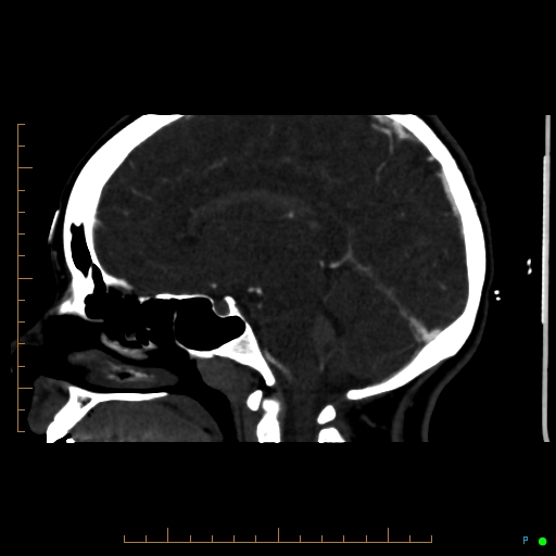 Cerebral arteriovenous malformation (AVM) (Radiopaedia 78162-90706 Sagittal CTA 39).jpg