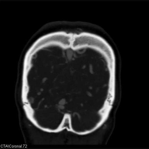 Cerebral arteriovenous malformation (Radiopaedia 28518-28759 C 72).jpg