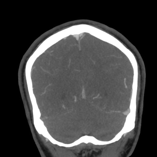 File:Cerebral arteriovenous malformation (Radiopaedia 39259-41505 E 53).png