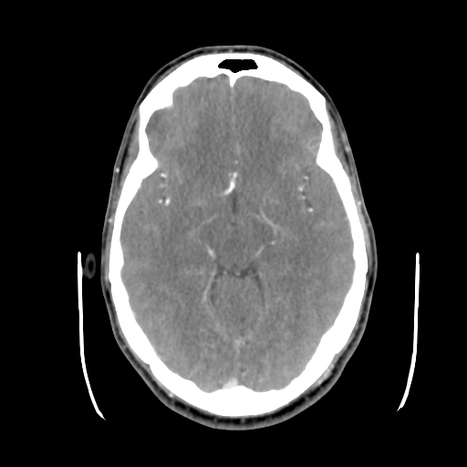 Cerebral arteriovenous malformation (Radiopaedia 55798-62371 B 21).png