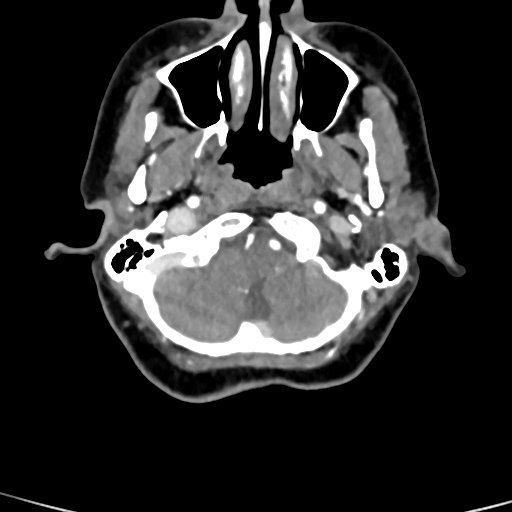 Cerebral arteriovenous malformation (Radiopaedia 73830-84645 B 89).jpg