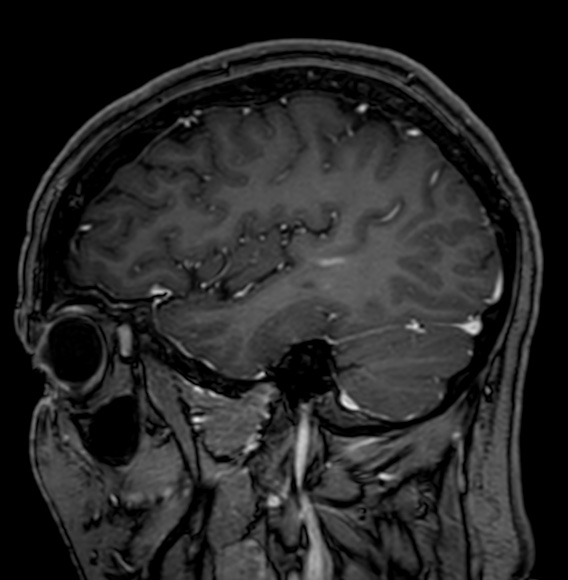 Cerebral arteriovenous malformation (Radiopaedia 74411-85746 Sagittal T1 C+ 27).jpg