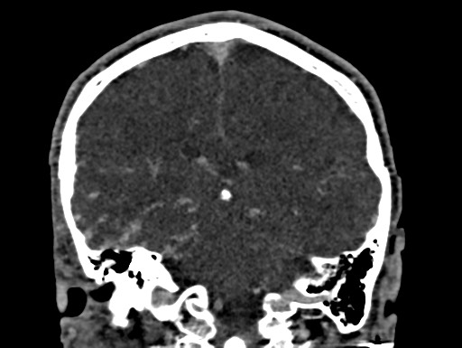 Cerebral arteriovenous malformation (Radiopaedia 78188-90746 Coronal C+ delayed 74).jpg