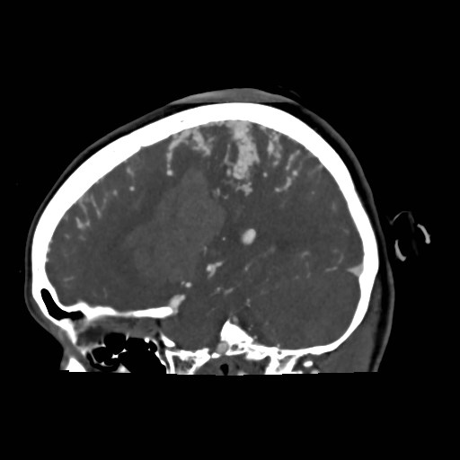 File:Cerebral arteriovenous malformation (Radiopaedia 79677-92888 C 11).jpg
