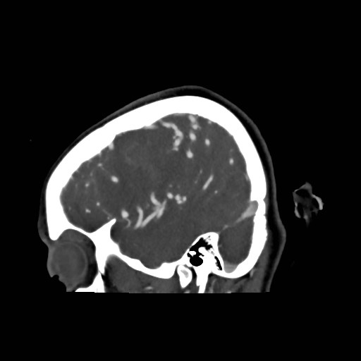 File:Cerebral arteriovenous malformation (Radiopaedia 79677-92888 C 5).jpg